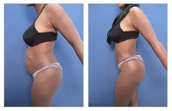 Liposuction Before & After Liposuction Before & After