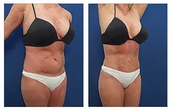 Vaser Lipo Pros and Cons Vaser Lipo Pros and Cons