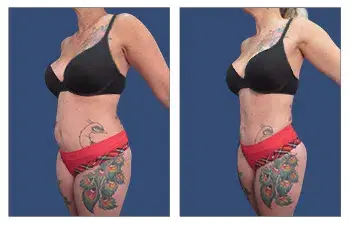 A woman undergoes liposuction and showcases her before and after tattoos. A woman undergoes liposuction and showcases her before and after tattoos.