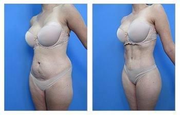 A woman's breast before and after surgery for breast augmentation. A woman's breast before and after surgery for breast augmentation.