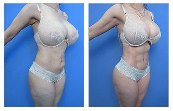 VASER Liposuction tummy tuck before and after. VASER Liposuction tummy tuck before and after.