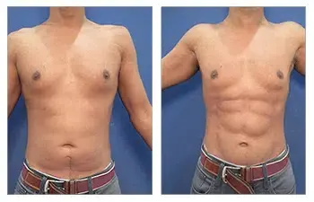 Tummy tuck before and after with vaser lipo in the UK. Tummy tuck before and after with vaser lipo in the UK.