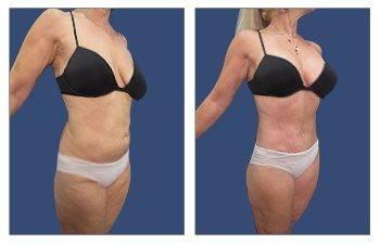 Before and after pictures showcasing a woman's tummy tuck transformation, correcting contour irregularities. Before and after pictures showcasing a woman's tummy tuck transformation, correcting contour irregularities.