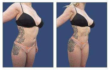 Before and after pictures of a woman's tummy tuck in Southern California. Before and after pictures of a woman's tummy tuck in Southern California.