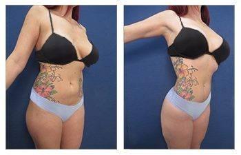 Airsculpt Liposuction vs VASER HD Lipo Airsculpt Liposuction vs VASER HD Lipo