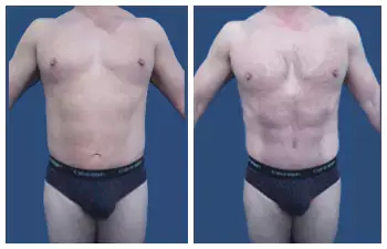 Liposuction Abdoominal Before and After Liposuction Abdoominal Before and After