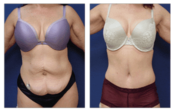 Tummy Tuck — #SS179 Tummy Tuck — #SS179