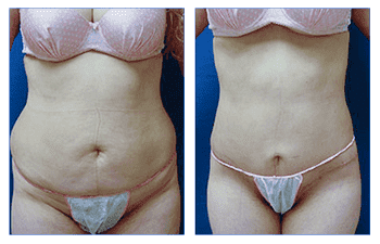 Mini Tummy Tuck — #SS286 Mini Tummy Tuck — #SS286