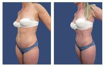 Mini tummy tuck before and after in Los Angeles. Mini tummy tuck before and after in Los Angeles.