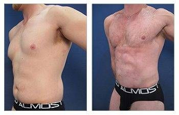 HD Liposuction + Mini Tummy Tuck — #SS095 HD Liposuction + Mini Tummy Tuck — #SS095