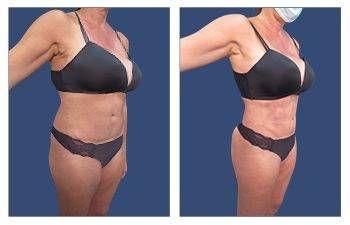 Before and after pictures showcasing a woman's transformation after a mini tummy tuck in Newport Beach. Before and after pictures showcasing a woman's transformation after a mini tummy tuck in Newport Beach.