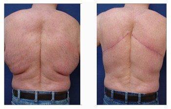 post bariatric surgery patient 2 back view post bariatric surgery patient 2 back view