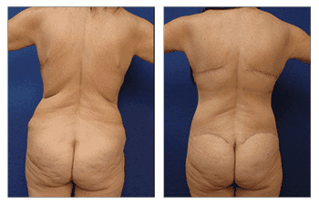 Bariatric tummy tuck before and after. Bariatric tummy tuck before and after.