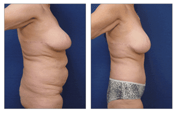 Tummy tuck before and after / Insurance Coverage for Body Lift Tummy tuck before and after / Insurance Coverage for Body Lift