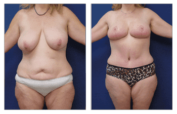 Body lift before and after weight loss. Body lift before and after weight loss.