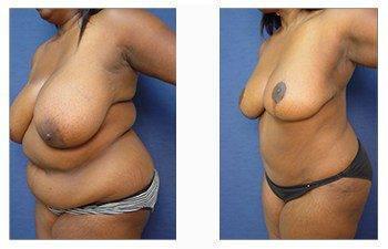 post bariatric surgery patient 16 front left post bariatric surgery patient 16 front left