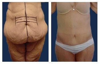 Post Bariatric Surgery — #SS289 Post Bariatric Surgery — #SS289