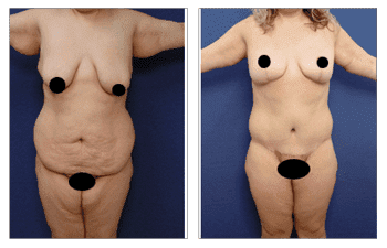 Tummy tuck before and after - How Painful is Post Bariatric Body Lift? Tummy tuck before and after - How Painful is Post Bariatric Body Lift?