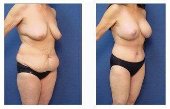 post bariatric surgery patient 3 front right post bariatric surgery patient 3 front right