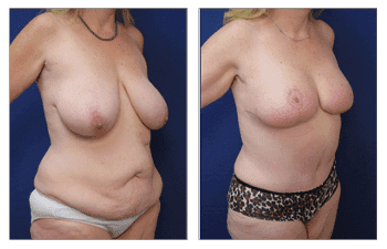 Body Lift After Weight Loss Body Lift After Weight Loss