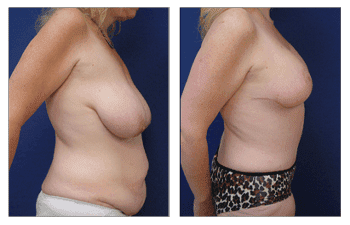 Body lift before and after weight loss. Body lift before and after weight loss.