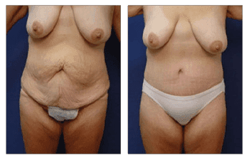Post-Bariatric Body Lift Beverly Hills Post-Bariatric Body Lift Beverly Hills