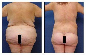 Post Bariatric Body Lift before and after photos showcasing the transformative effects of a tummy tuck procedure. Post Bariatric Body Lift before and after photos showcasing the transformative effects of a tummy tuck procedure.