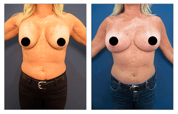 A woman's breast before and after undergoing a cosmetic surgery procedure commonly known as a "boob job.