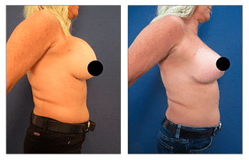 Boob Job to Fix Operated Looking Breasts Boob Job to Fix Operated Looking Breasts