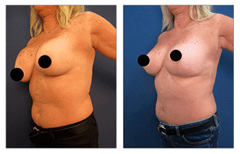 Boob Job to Fix Operated Looking Breasts Boob Job to Fix Operated Looking Breasts