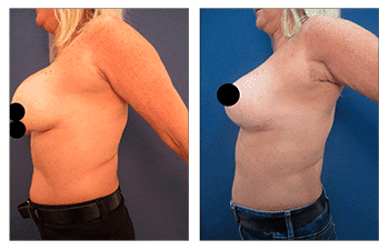 Boob Job to Fix Operated Looking Breasts Boob Job to Fix Operated Looking Breasts