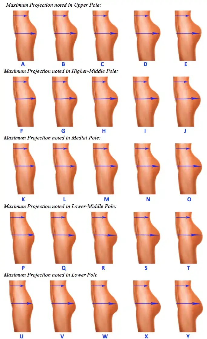 Brazilian Butt Lift Calculator LA-CA Brazilian Butt Lift Calculator LA-CA