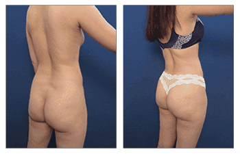 Hd Body Contouring Hd Body Contouring
