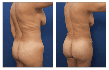 A woman's breasts before and after HD Liposuction surgery. A woman's breasts before and after HD Liposuction surgery.