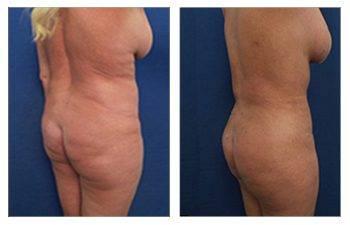 Brazilian Butt Lift Revision Specialist Brazilian Butt Lift Revision Specialist