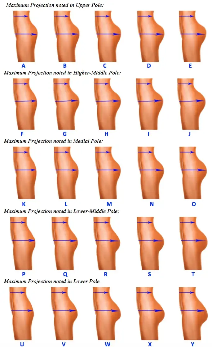 Brazilian Butt Lift vs Buttock Implant Calculator Brazilian Butt Lift vs Buttock Implant Calculator