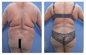 35-year-old female patient who had a Brazilian Buttock Lift – Rear view
