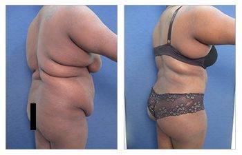 Brazilian Buttock Lift