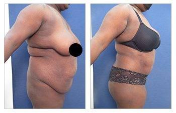 Brazilian Buttock Lift