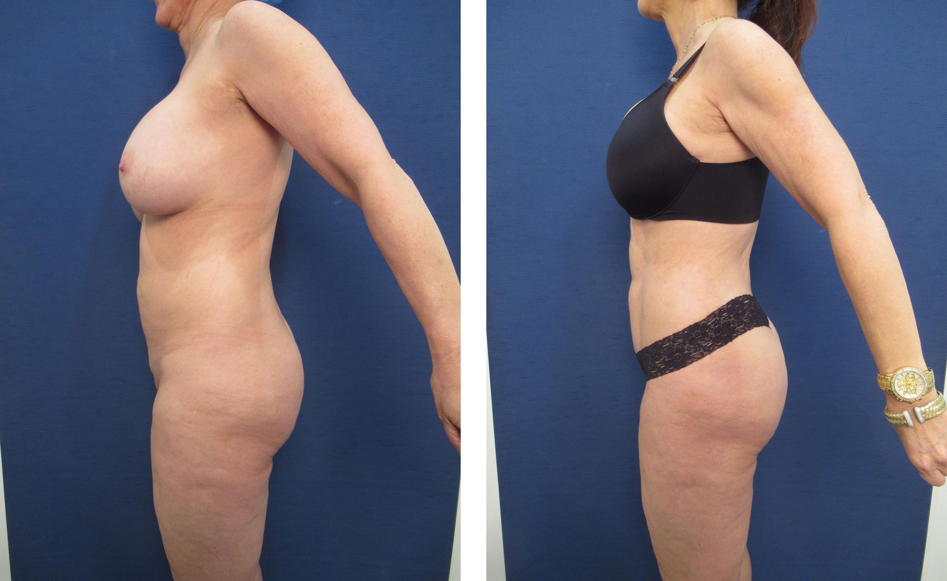 Brazilian Buttock Lift San Diego Brazilian Buttock Lift San Diego