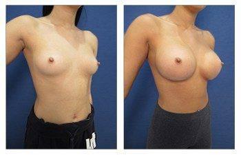 Breast Augmentation — #SS385 Breast Augmentation — #SS385