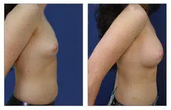 A woman's breast before and after Breast Augmentation surgery. A woman's breast before and after Breast Augmentation surgery.