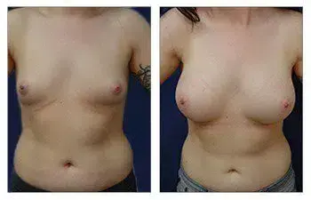 A woman's breast before and after Breast Augmentation surgery. A woman's breast before and after Breast Augmentation surgery.