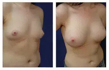 A woman's breast before and after Breast Augmentation surgery. A woman's breast before and after Breast Augmentation surgery.