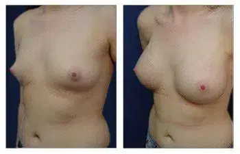 A woman's breast before and after a Breast Augmentation surgery. A woman's breast before and after a Breast Augmentation surgery.