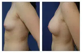Breast augmentation with fat transfer, showcasing stunning before and after results. Breast augmentation with fat transfer, showcasing stunning before and after results.