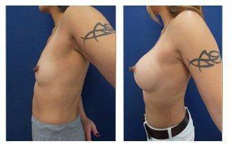 Breast Augmentation — #SS386 Breast Augmentation — #SS386