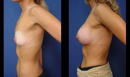 Breast Augmentation Orange County, CPSI, width: 419px; height: 251px