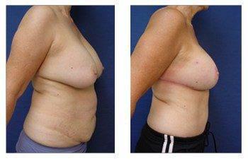 breast augmentation revision patient 1 right view breast augmentation revision patient 1 right view