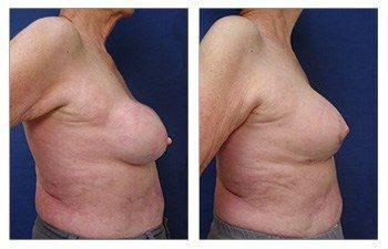 Breast Augmentation Revision in Los Angeles